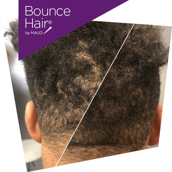 life_repair_alopecie_bounce_hair2 by maud