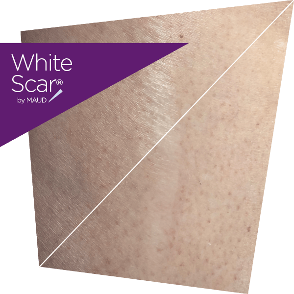 life_repair_cicatrice_white_scar - By Maud